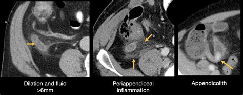 apendicita acuta|Appendizitis